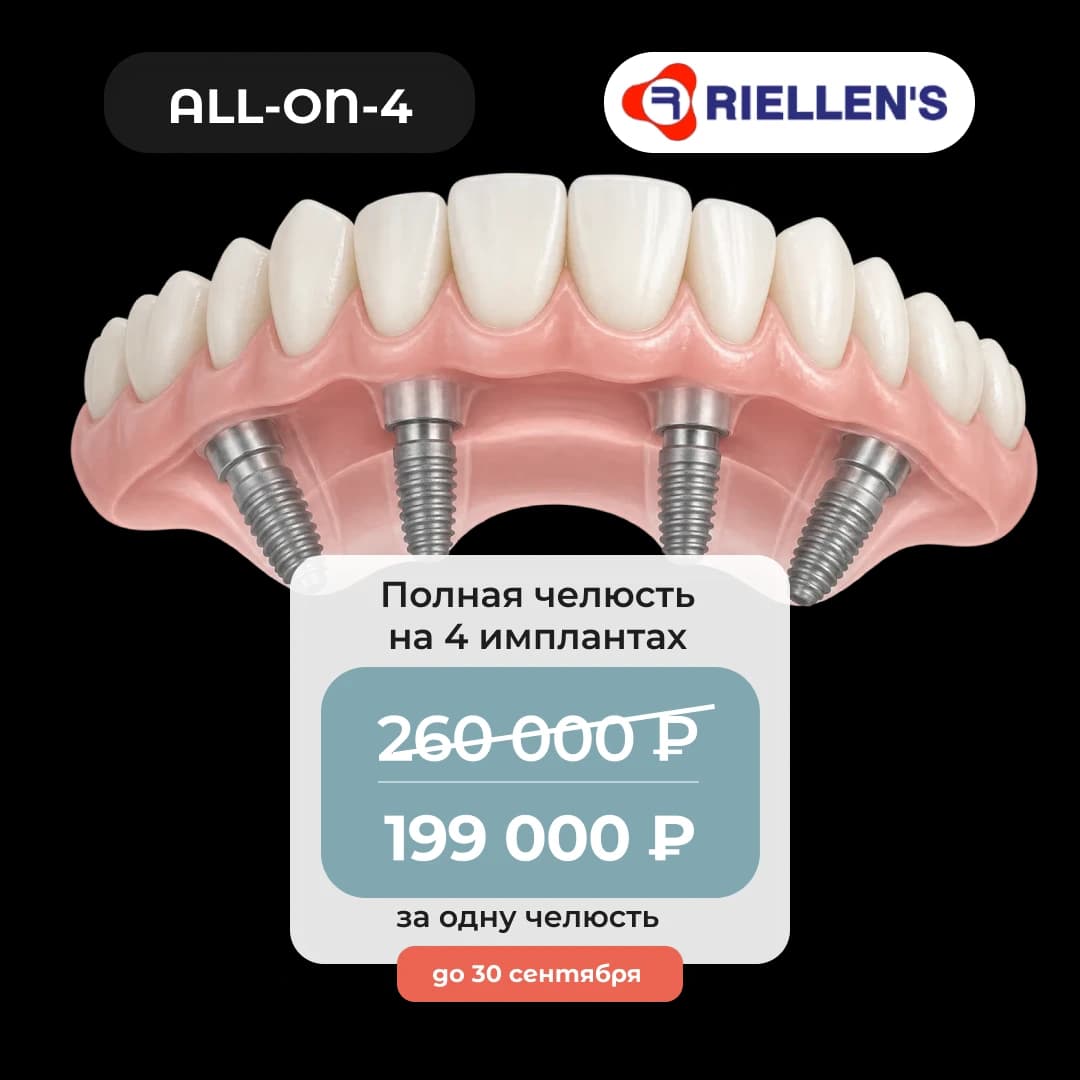 Вся челюсть на четырех имплантах Riellen's по методу All-on-4